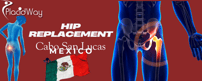 Hip Replacement in Cabo San Lucas, Mexico